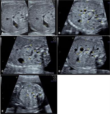 Ultrasound examination of the normal fetal duodenum